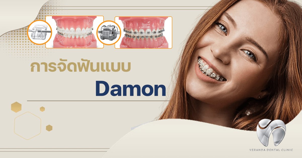What is Damon braces
