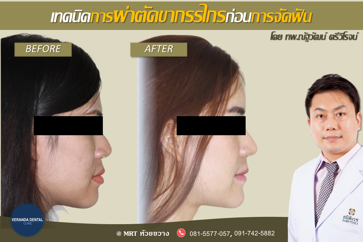 รีวิวจัดฟันร่วมกับการผ่าตัดขากรรไกร หลังผ่าตัดคนไข้หน้าเด็กลงมาก