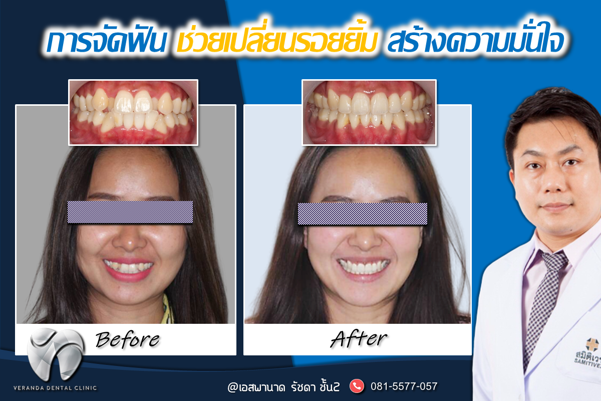 จัดฟันโดยทันตแพทย์เฉพาะทาง ลดฟันยื่น