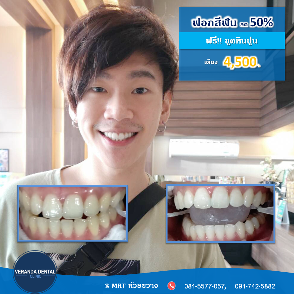 ฟันเหลืองขาวขึ้นได้ด้วยการฟอกสีฟัน