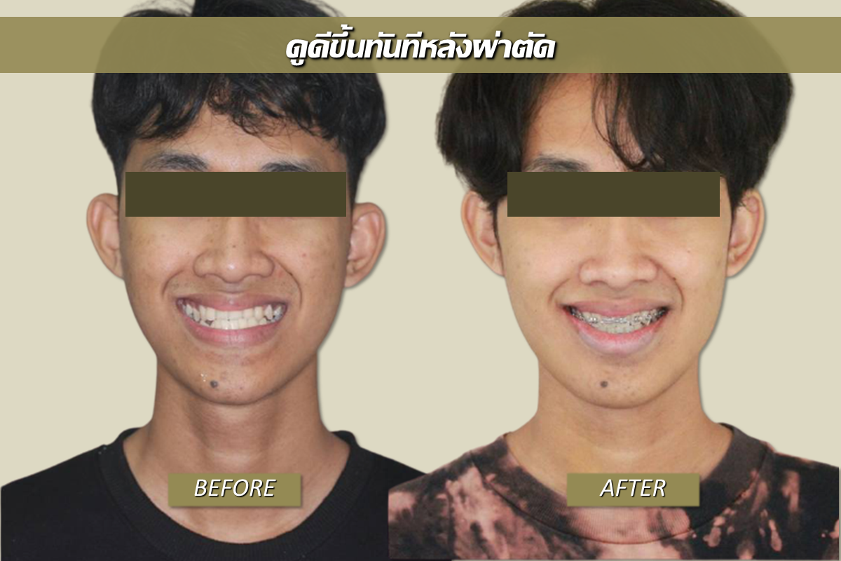 รีวิวแก้คางยื่น กับเทคนิคการผ่าตัดขากรรไกรก่อนจัดฟัน